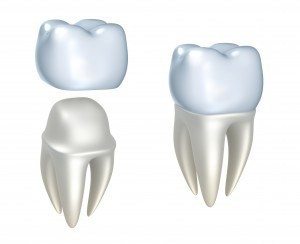 Graphic illustrating how the dental crown procedure works to restore a damaged tooth
