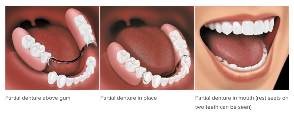 dentures removable replacement tooth partial denture teeth dental missing partials acrylic base gums dentist options shifting call left dentistry